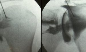 Arthrography